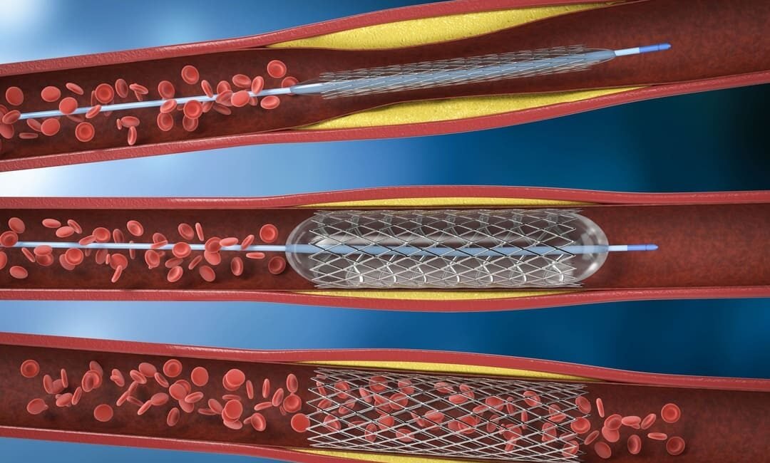 Angioplastia coronariana com implante de stent farmacológico.