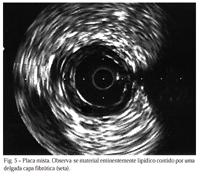 Imagem intravascular