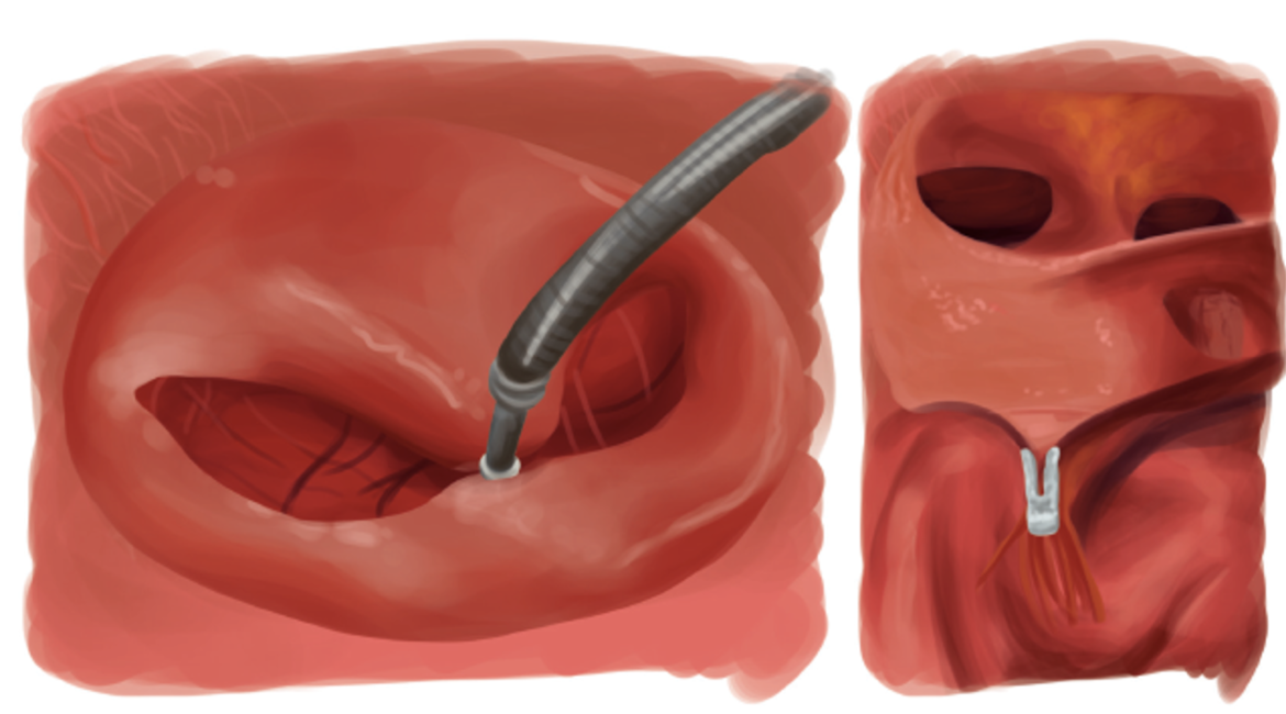 Reparo transcateter da valva mitral (Mitraclip ®)