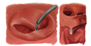 Reparo transcateter da valva mitral (Mitraclip ®)