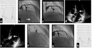 Alcoolização septal percutânea no tratamento de miocardiopatia hipertrófica obstrutiva.