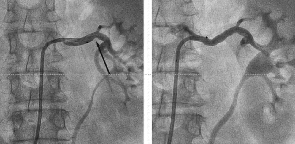 Denervação simpática renal percutânea