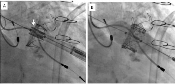 Valve-in-Valve Mitral e Aórtico