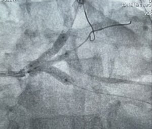 Angioplastias complexas – CHIP – Complex High Risk Indicated Procedures