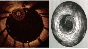 Imagem intravascular (ultrassom e tomografia de coerência óptica intracoronariana – IVUS e OCT)