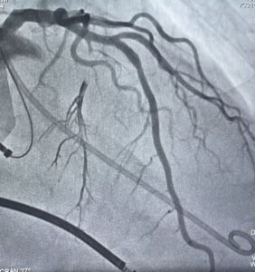 Ablação septal para tratamento de cardiomiopatia hipertrófica obstrutiva