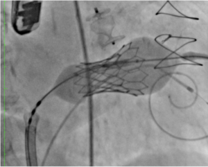 Valve-in-Valve (Mitral, Aórtico ou Tricúspide)